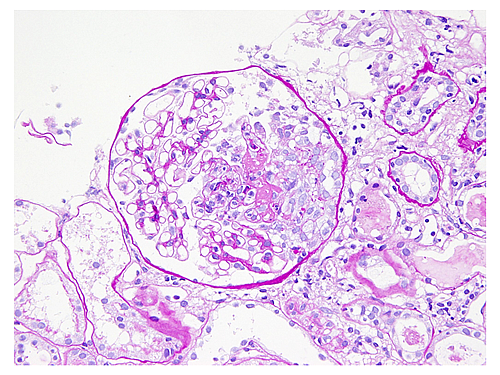 糸球体毛細血管炎のある糸球体