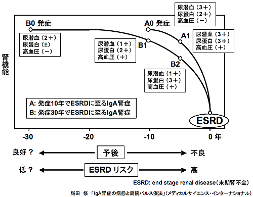 IgA腎症の歴史とIgA腎症に対する認識の変遷
